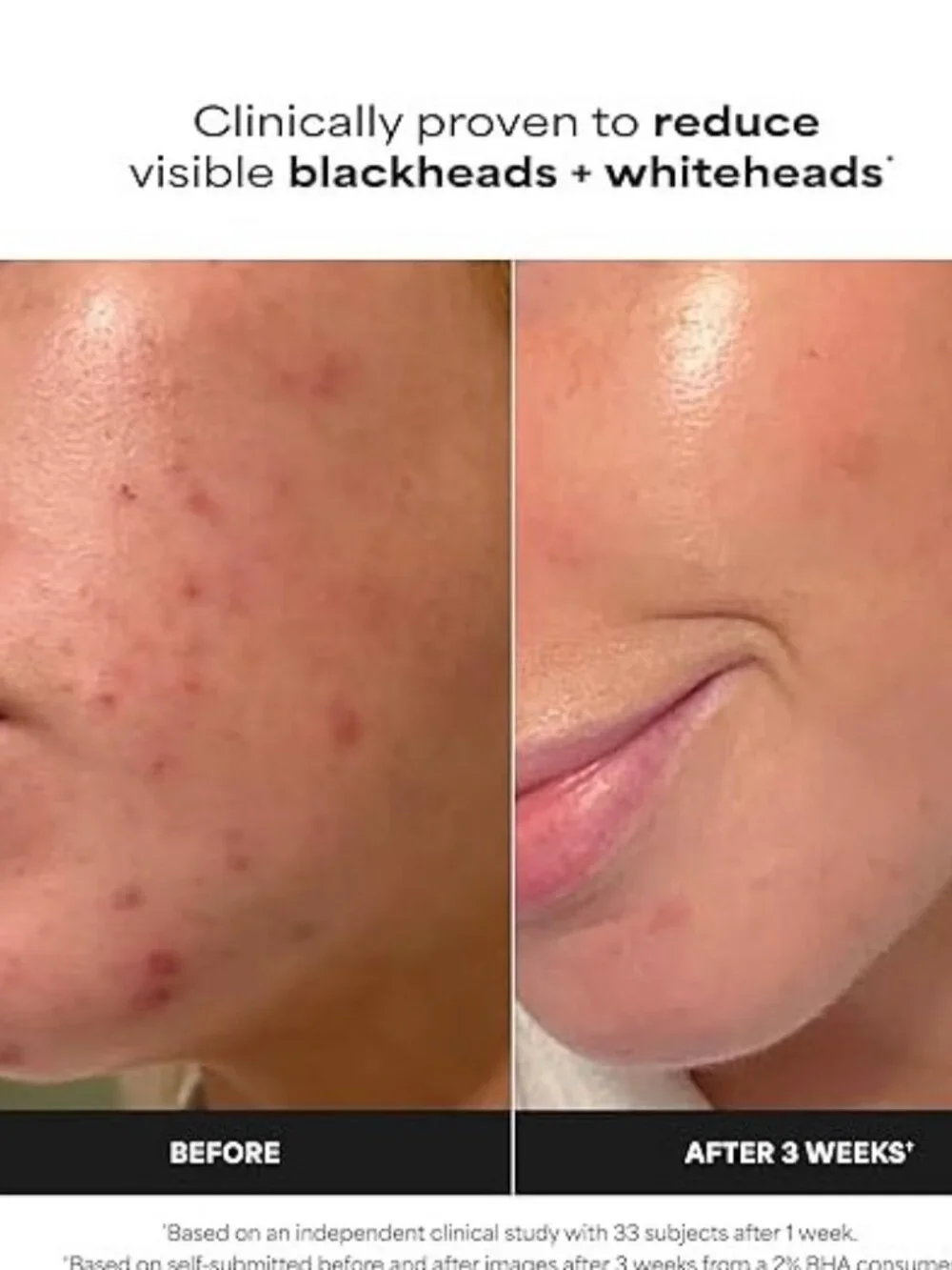 Paula's Choice SKIN PERFECTING 2% BHA Liquid Exfoliant & Pads Unisex